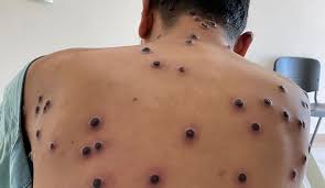 Erupciones por viruela símica